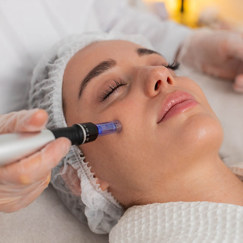 Microneedling in Sherman Oaks, CA